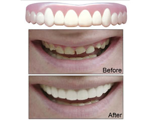 Link to more info about Snap On Smile