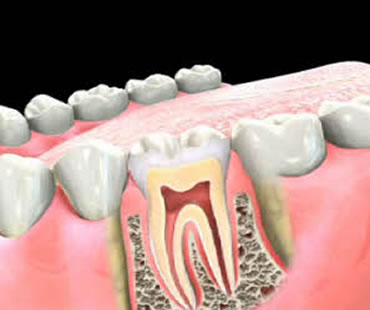 Endodontists: The Root Canal Treatment Specialists