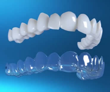 Adults: Living with Invisalign