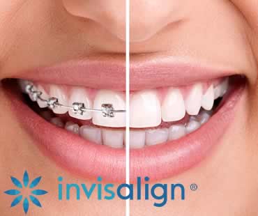 Daily Care of Your Invisalign Aligners