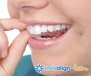 How to Prepare Your Teen for Invisalign