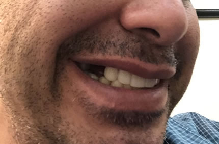 dental patient smile before