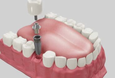 The Numerous Benefits of Dental Implants