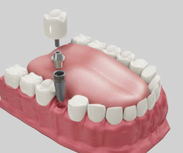 The Numerous Benefits of Dental Implants