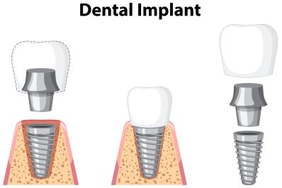 dentalimplant