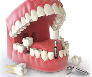 Private: Benefits of Dental Implants